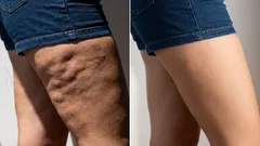 5 abitudini per eliminare definitivamente la cellulite su cosce e glutei
